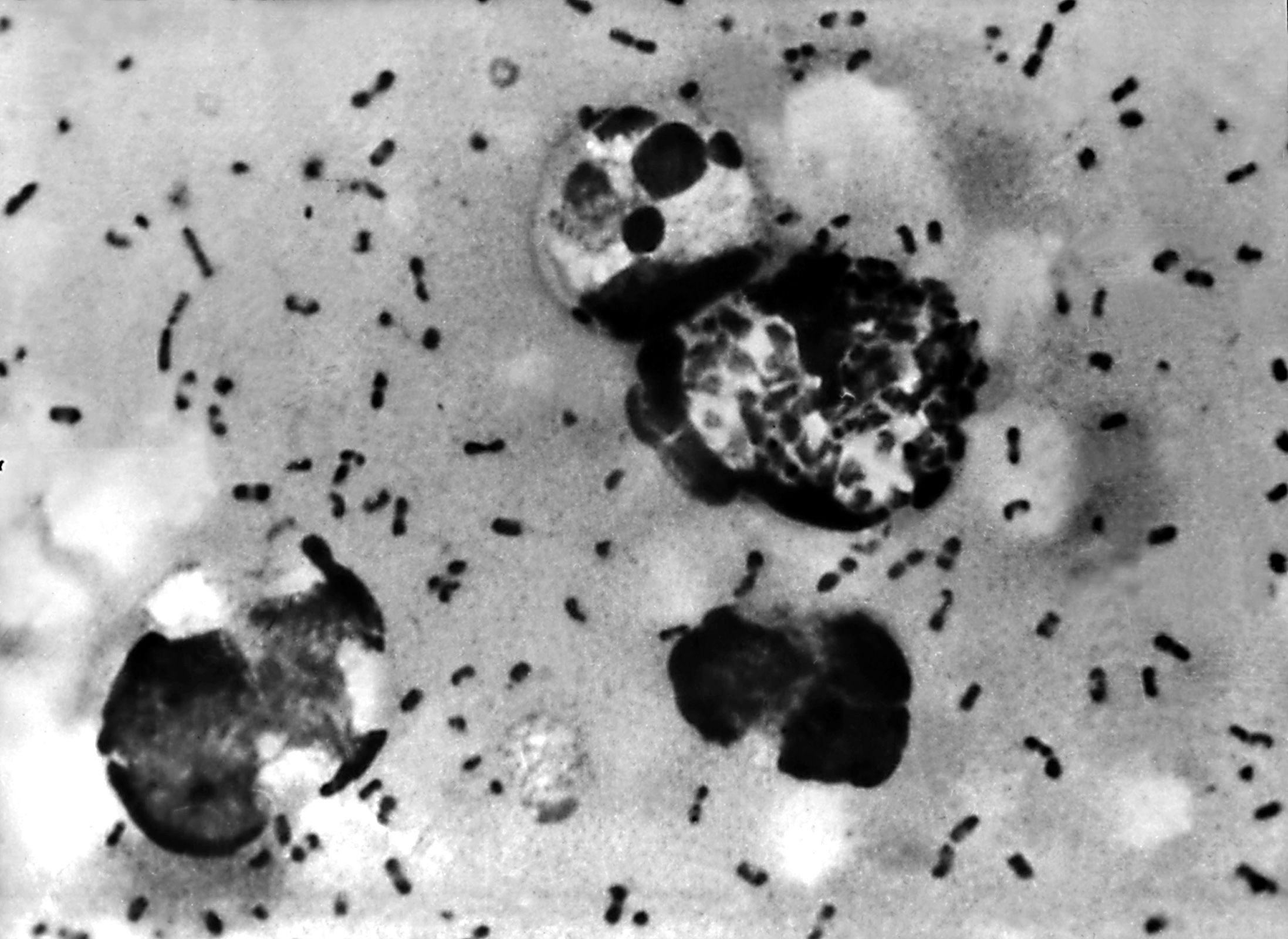 ¿Qué es la peste pulmonar y qué tan peligrosa es?